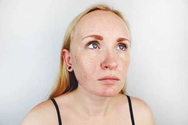 Oily Problem Skin Portrait Blonde Girl Acne Oily Skin Pigmentation — Stock Photo, Image