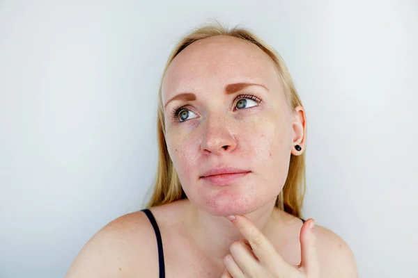 Olejnatá Problémová Kůže Portrét Blondýnky Akné Mastnou Pletí Pigmentací — Stock fotografie