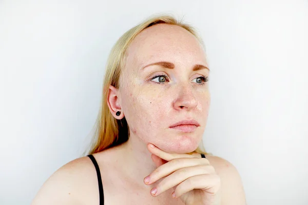 Olejnatá Problémová Kůže Portrét Blondýnky Akné Mastnou Pletí Pigmentací — Stock fotografie
