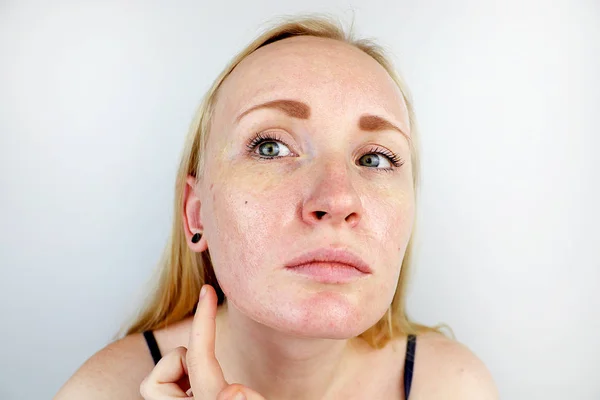 Oily Problem Skin Portrait Blonde Girl Acne Oily Skin Pigmentation — Stock Photo, Image