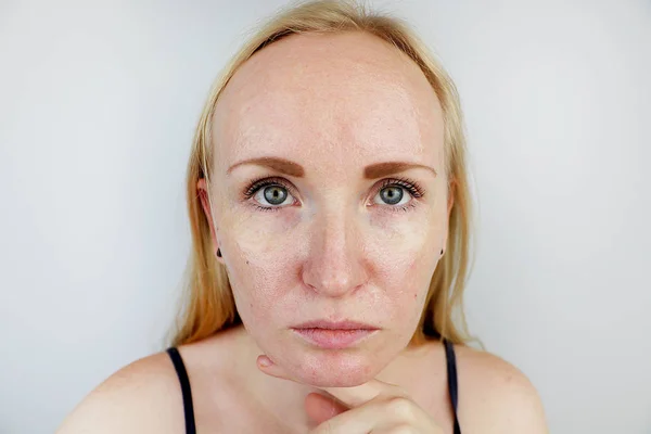 Olajos Problémás Bőr Portré Egy Szőke Lány Akne Zsíros Bőr — Stock Fotó