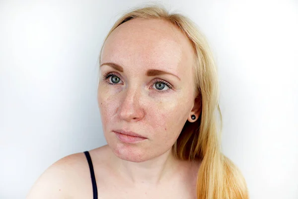 Oily Problem Skin Portrait Blonde Girl Acne Oily Skin Pigmentation — Stock Photo, Image