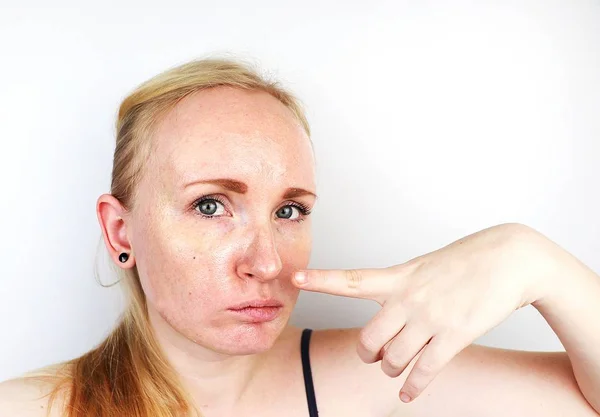 Pele Oleosa Problemática Retrato Uma Menina Loira Com Acne Pele — Fotografia de Stock