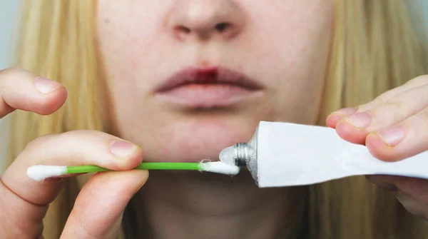 Una Mujer Pone Los Labios Ungüento Herpes — Foto de Stock