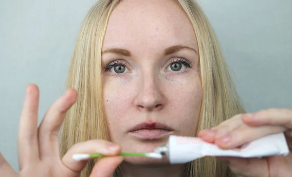 Een Vrouw Zet Lippen Zalf Van Herpes — Stockfoto