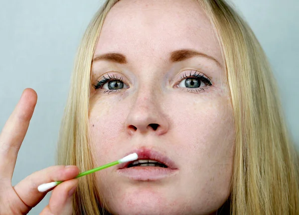 Wanita Muda Yang Cantik Bibir Terinfeksi Virus Herpes Konsep Pengobatan — Stok Foto