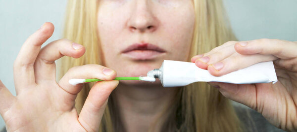 A woman puts on the lips ointment from herpes