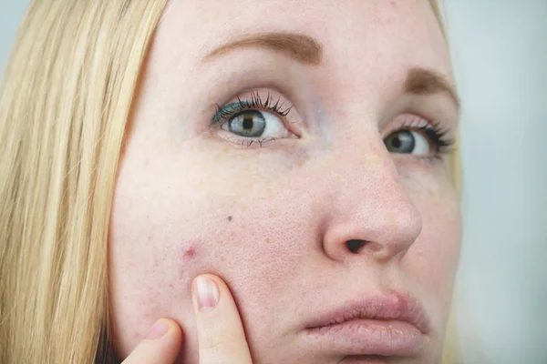 Jonge Vrouw Met Acne Het Toepassen Van Zalf Het Puistje — Stockfoto