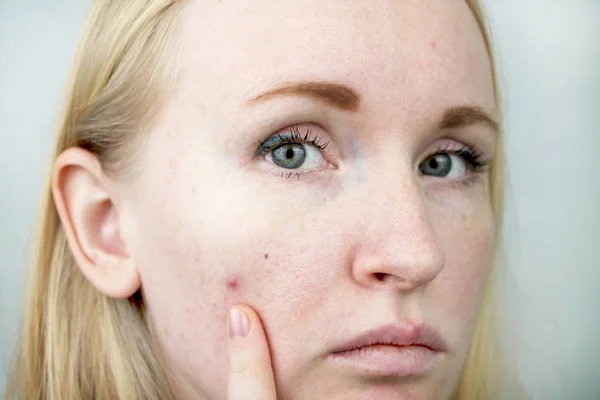 Mujer Joven Con Acné Aplicando Ungüento Espinilla Belleza Cuidado Piel — Foto de Stock