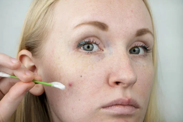 Mujer Joven Con Acné Aplicando Ungüento Espinilla Belleza Cuidado Piel — Foto de Stock