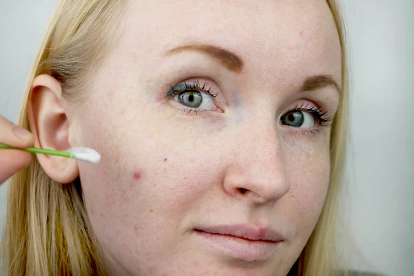 Jonge Vrouw Met Acne Het Toepassen Van Zalf Het Puistje — Stockfoto