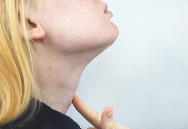 Щитовидная Железа Крупный План Портрета Симпатичной Больной Молодой Блондинки Белом — стоковое фото