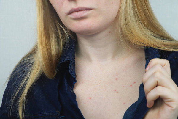 Allergy concept. Young woman with pimples on the chest, closeup