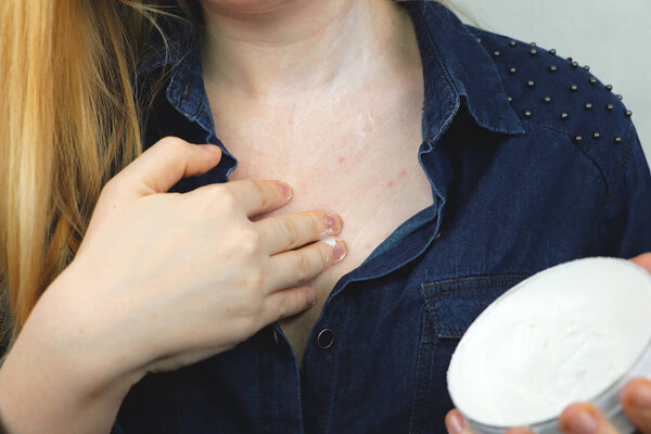 Allergy concept. Young woman with pimples on the chest, closeup