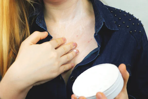 Allergy Concept Young Woman Pimples Chest Closeup — Stock Photo, Image
