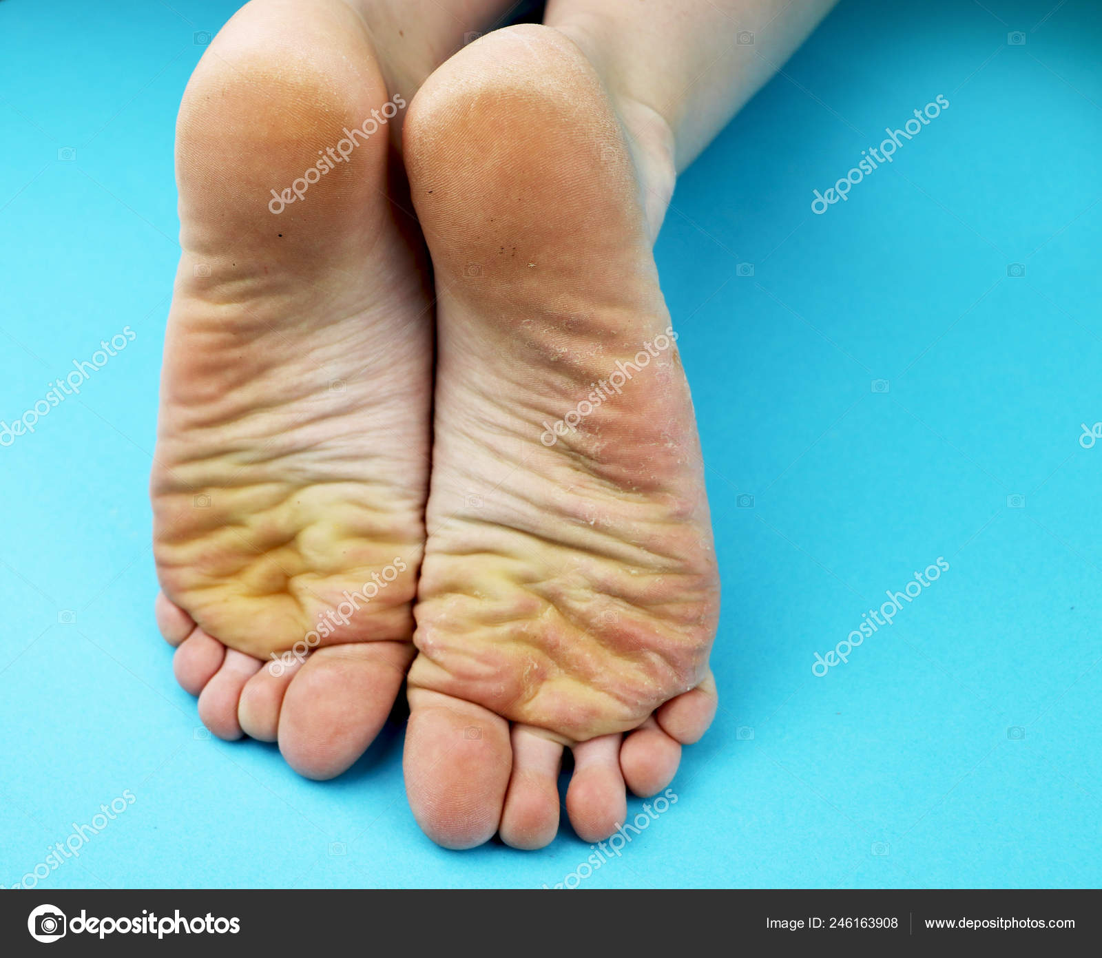 Почему у ребенка желтые пятки. Эпидермолитический гиперкератоз. Бородавчатый гиперкератоз. Почему у ребенка желтые пятки. Плантарный фасциит стопы гимнастика.