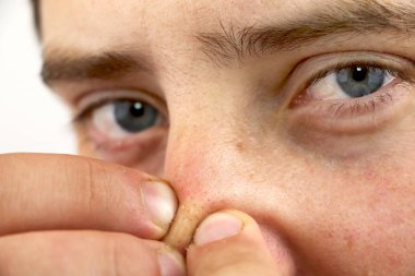 Sivilce veya siyah nokta burnuna sıkma kameraya, seyir portre portre genç adam. Yakın çekim yüz ve burun hijyen için arka plan olarak. Dermatoloji ve cilt problemleri. Yağlı cilt yüz