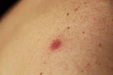 Bir sivilce irin bir adam arkasında ile fotoğrafı