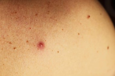 Bir sivilce irin bir adam arkasında ile fotoğrafı