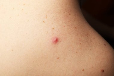 Bir sivilce irin bir adam arkasında ile fotoğrafı