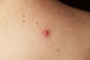 Bir sivilce irin bir adam arkasında ile fotoğrafı