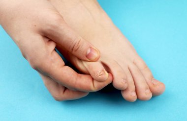 Mantar ayak yakın çekim, izole mavi arka plan üzerinde. Kavram Dermatoloji, insanlarda tedavi mantar, küf ve mantar enfeksiyonları. Makro fotoğraf insan parazitler. Arka arka plan bir dermatolog