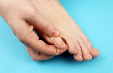 Fungus of foot close-up, isolated on blue background. The concept dermatology, treatment fungal and fungal infections in humans. Macro photograph human parasites. Rear background of a dermatologist clipart