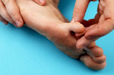 Mantar ayak yakın çekim, izole mavi arka plan üzerinde. Kavram Dermatoloji, insanlarda tedavi mantar, küf ve mantar enfeksiyonları. Makro fotoğraf insan parazitler. Arka arka plan bir dermatolog