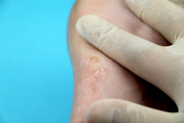Mantar ayak yakın çekim, izole mavi arka plan üzerinde. Kavram Dermatoloji, insanlarda tedavi mantar, küf ve mantar enfeksiyonları. Makro fotoğraf insan parazitler. Arka arka plan bir dermatolog
