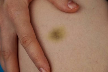 Parlak genç kadın bacak üzerinde hasar çürük. Bir kız ile bir çürük Yaralı diz parmaklarını iyileştirici bir merhem ile losyonları. Ağrı kavramı kapat-up.hematoma leg.bruise bacak üzerinde