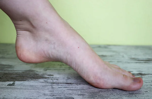 Bir Kadın Ayak Üzerinde Varisli Damarlar — Stok fotoğraf