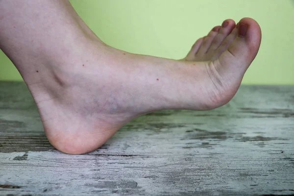 Bir Kadın Ayak Üzerinde Varisli Damarlar — Stok fotoğraf