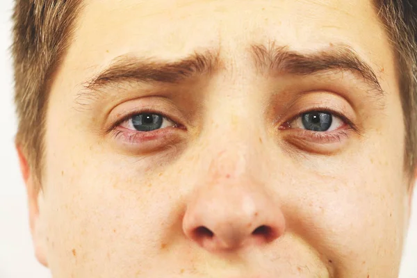 Conjuntivitis Ojos Cansados Ojos Rojos Enfermedades Oculares — Foto de Stock