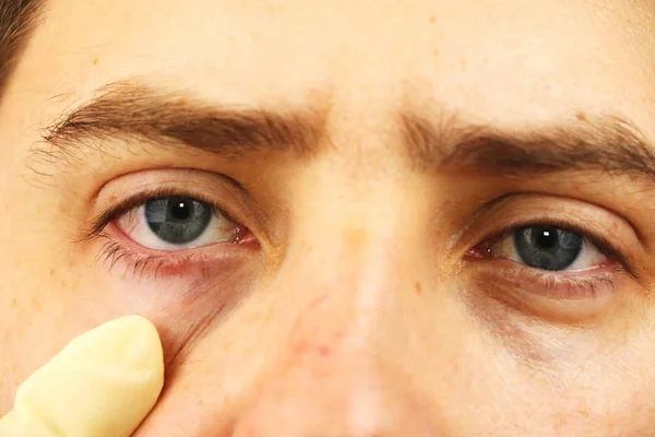 Conjunctivitis Tired Eyes Red Eyes Eye Disease — Stock Photo, Image