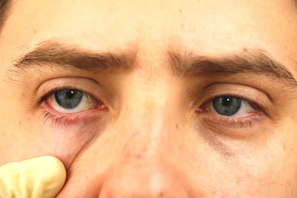 Sidekalvotulehdus Väsyneet Silmät Punaiset Silmät Silmäsairaus — kuvapankkivalokuva