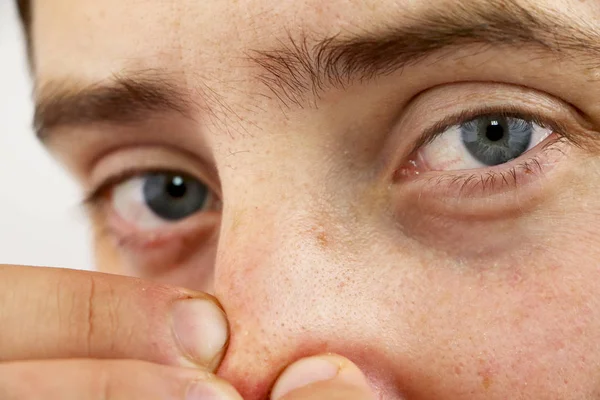 Closeup portrait young man looking at the camera, squeezing acne or blackheads on the nose. Close-up as background for the hygiene of the face and nose. Dermatology and skin problems. Oily skin face