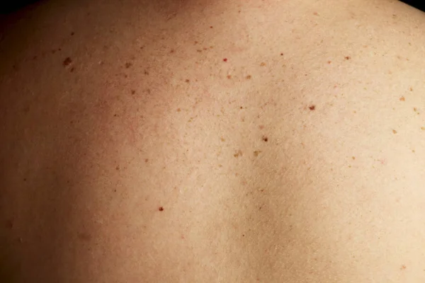 Close Detail Bare Skin Man Back Scattered Moles Freckles Disorders — Stock Photo, Image