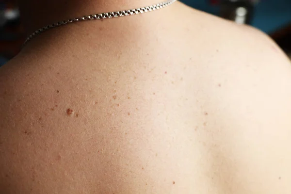 Közelkép Csupasz Bőr Ember Vissza Szétszórt Anyajegyek Szeplő Test Ellenőrzése — Stock Fotó