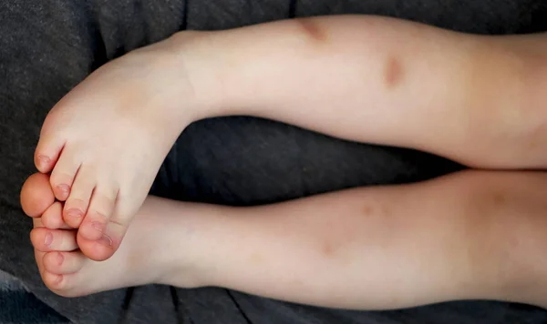 男孩腿上的伤痕 — 图库照片