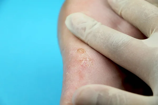 Fungus Foot Close Isolated Blue Background Concept Dermatology Treatment Fungal — Stock Photo, Image