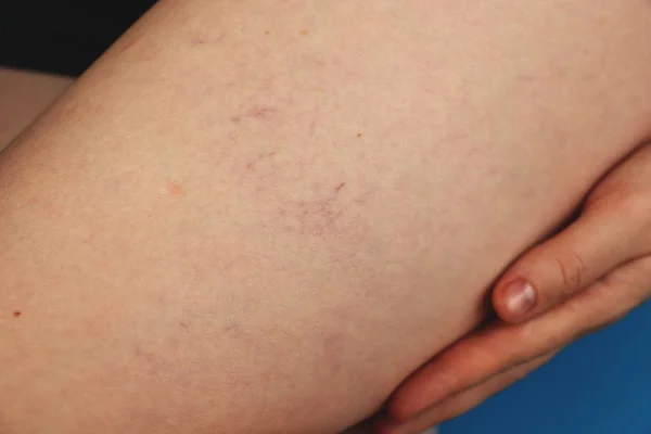 Varices Veines Capillaires Dans Les Jambes Inspection Traitement Médicaux — Photo