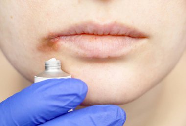 Dudaklarında uçuk: nezle ve herpes virüsü bir kadınla bir dermatolog ve enfeksiyon hastalıkları uzmanı tarafından muayene