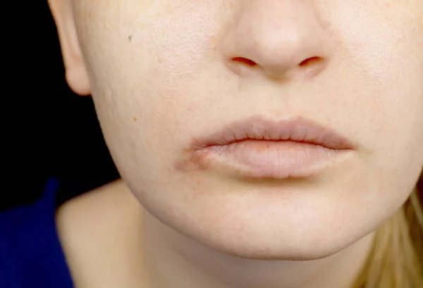 Herpes Pada Bibir Seorang Wanita Dengan Pilek Dan Virus Herpes — Stok Foto