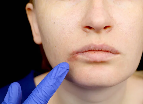 Herpes Lips Woman Cold Herpes Virus Examined Dermatologist Infectious Disease — Stock Photo, Image