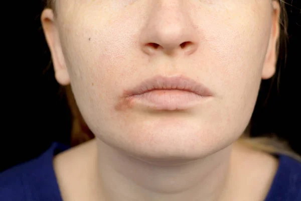 嘴唇上的疱疹 一名感冒和疱疹病毒的妇女接受皮肤科医生和传染病专家的检查 — 图库照片