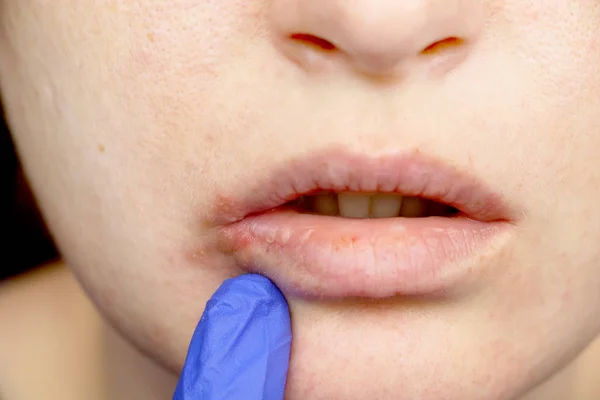 嘴唇上的疱疹 一名感冒和疱疹病毒的妇女接受皮肤科医生和传染病专家的检查 — 图库照片