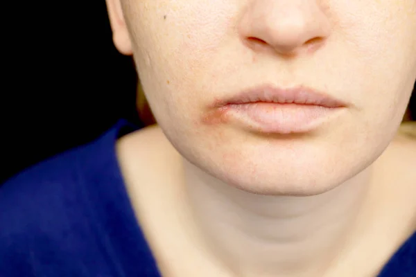 Herpes Nos Lábios Uma Mulher Com Resfriado Vírus Herpes Examinado — Fotografia de Stock