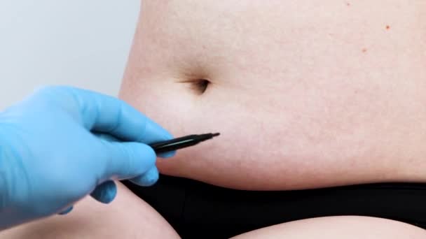 Karın Germe Torsoplasty Karın Liposuction Önlük Kaldırılması Plastik Cerrah Resepsiyonda — Stok video