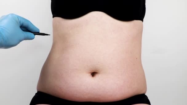 Abdominoplasty Torsoplasty 흡입과 앞치마의 리셉션에서 — 비디오