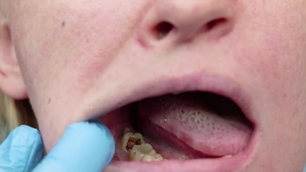 Derin Çürük Açık Kanallar Kanal Temizleme Stomatolon Giriş Periodontitis Tedavi — Stok video